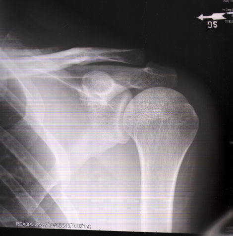 Xray of a rotator cuff injury - Scrollin' On Dubs